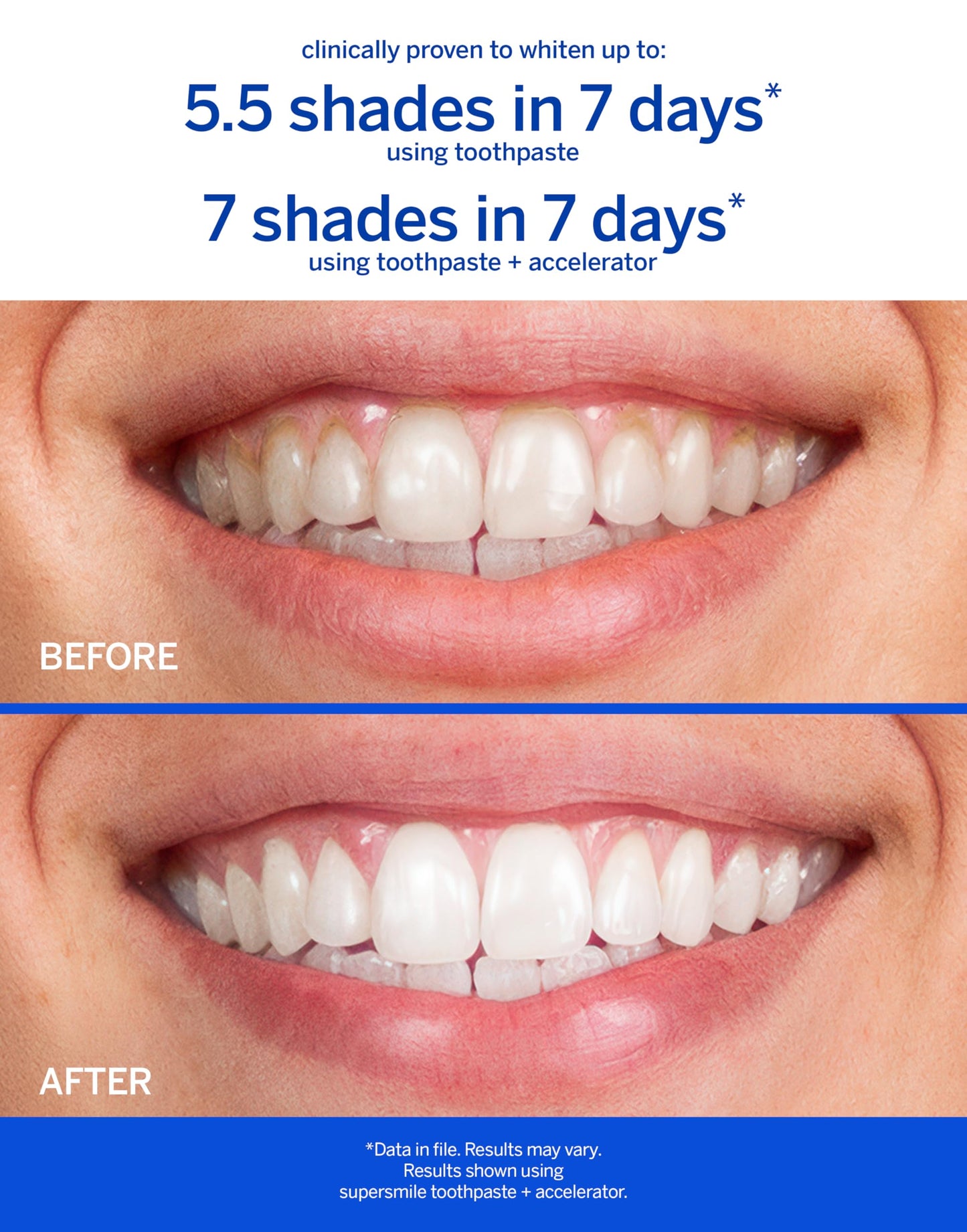 Supersmile Professional Whitening Toothpaste – Fluoride Toothpaste for Visibly Whiter Teeth – Whitens up to 6 Shades