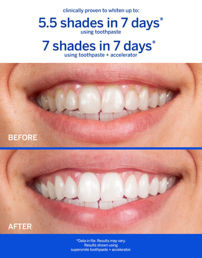 Supersmile Professional Whitening Toothpaste – Fluoride Toothpaste for Visibly Whiter Teeth – Whitens up to 6 Shades