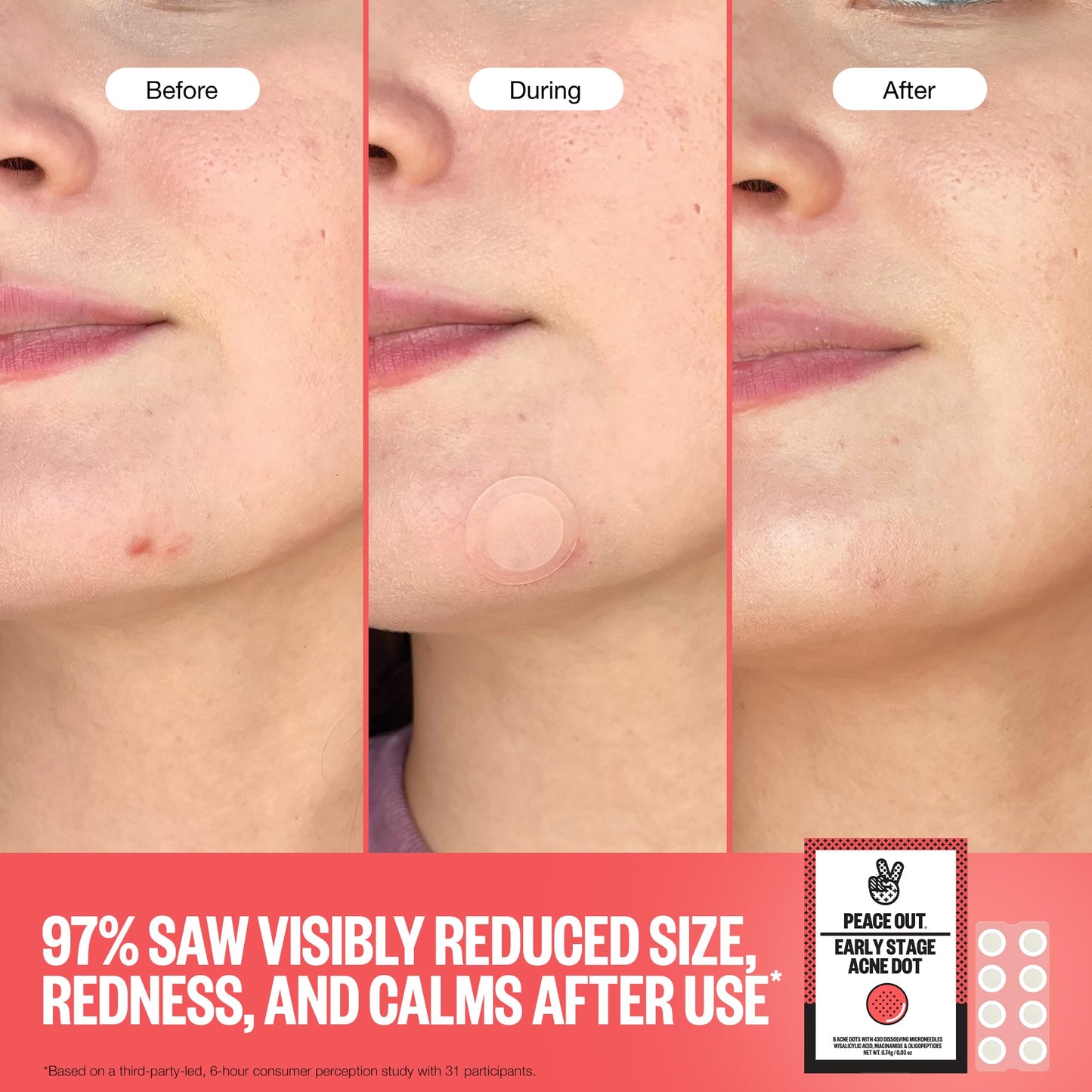 PEACE OUT Early Stage Acne Dots Helps Target Blemishes Below the Surface, Hydrocolloid Pimple Patches Minimize Bumps Before They Appear with Dissolving Microneedles, Salicylic Acid, 8 Count