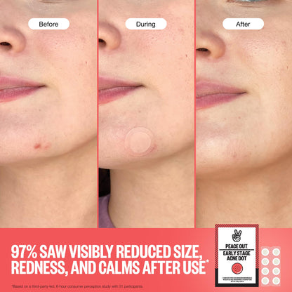 PEACE OUT Early Stage Acne Dots Helps Target Blemishes Below the Surface, Hydrocolloid Pimple Patches Minimize Bumps Before They Appear with Dissolving Microneedles, Salicylic Acid, 8 Count