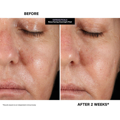 Kate Somerville KateCeuticals® Resurfacing Overnight Peel – Clinic-Grade Face Peel, Powerful Anti-Aging Treatment, 1 Fl Oz