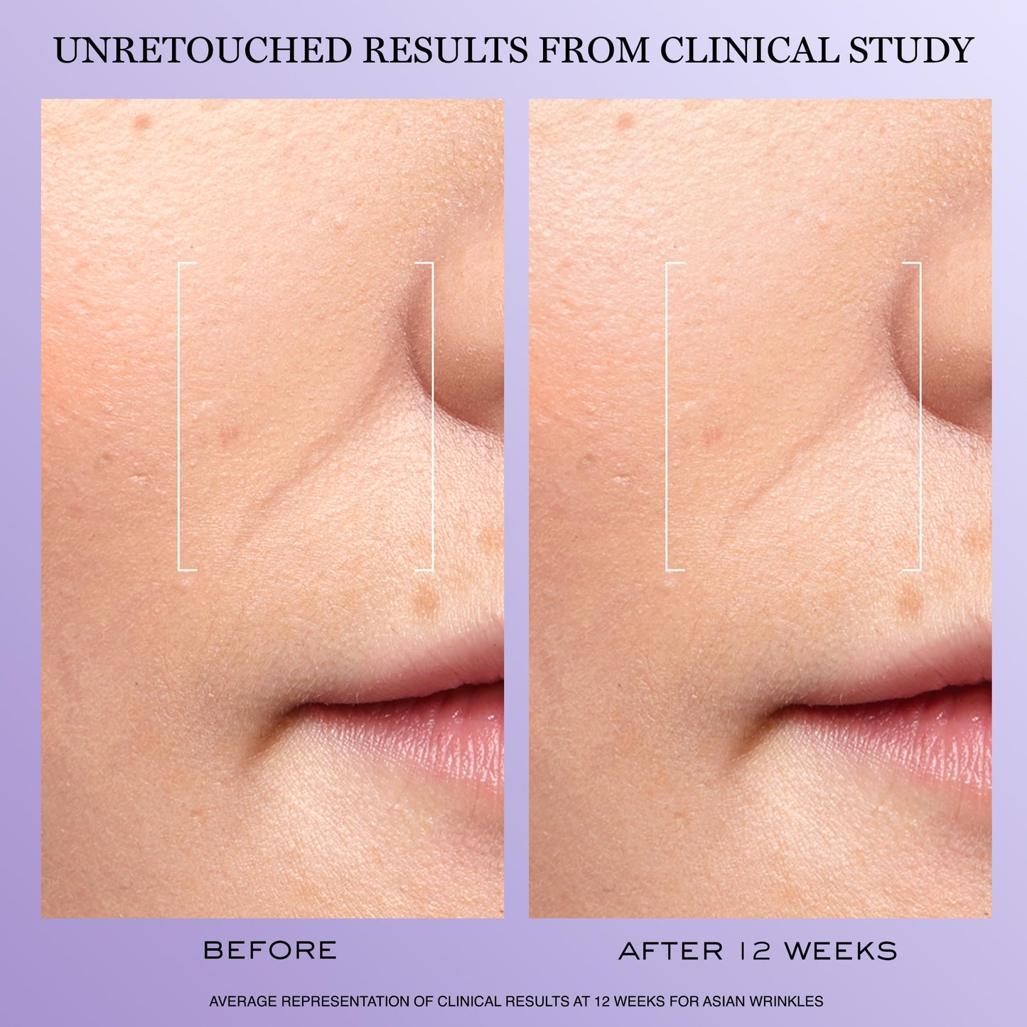 Lancôme Rénergie H.C.F. Triple Serum - Hyaluronic Acid Serum for Visible Correction of Anti Aging Signs & Dark Spots - With Vitamin C+, Niacinamide & Ferulic Acid