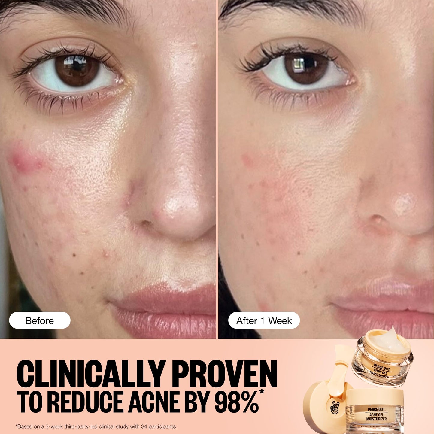 PEACE OUT Acne Gel Moisturizer for Oily Skin, Face Cream for Acne-Prone Skin with 2% Salicylic Acid, Niacinamide and Ceramides, 1.69 fl oz