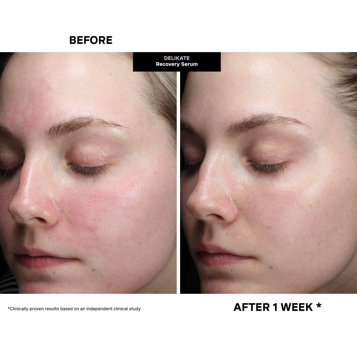 Kate Somerville DeliKate Recovery Serum – Clinically Formulated Hydrating Treatment, Irritation and Redness Relief for Stressed or Sensitive Skin, 1 Fl Oz