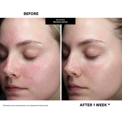 Kate Somerville DeliKate Recovery Serum – Clinically Formulated Hydrating Treatment, Irritation and Redness Relief for Stressed or Sensitive Skin, 1 Fl Oz
