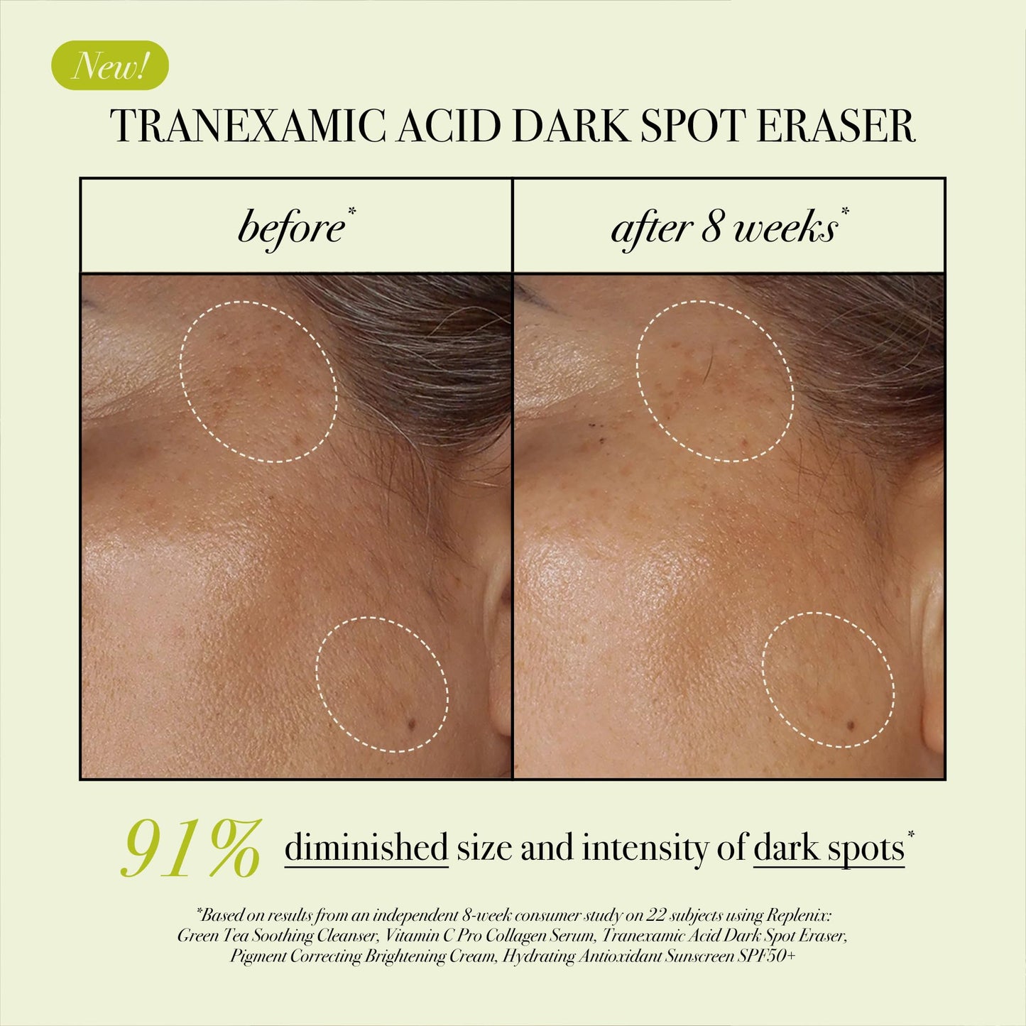 Replenix Tranexamic Acid Dark Spot Treatment, Daily Medical-Grade Topical Discoloration Serum for Uneven Skin Tone, Gluten, Paraben, Fragrance & Cruelty Free (0.5 oz)