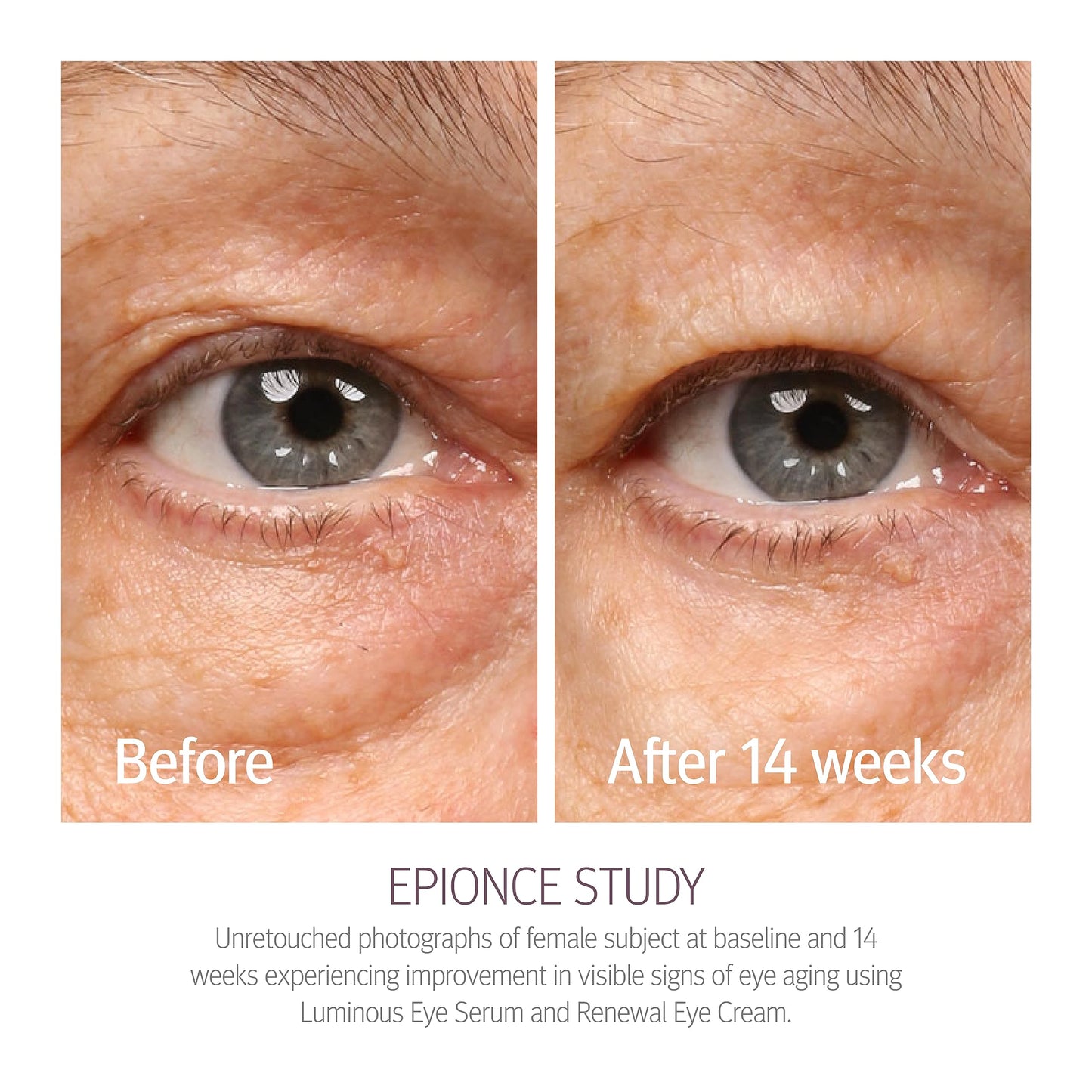 Epionce Renewal Eye Cream - Anti-Aging, Under Eye Cream for Dark Circles, Fine Lines, Wrinkles & Puffiness with Hyaluronic Acid, For All Skin Types, Dermatologist Skincare