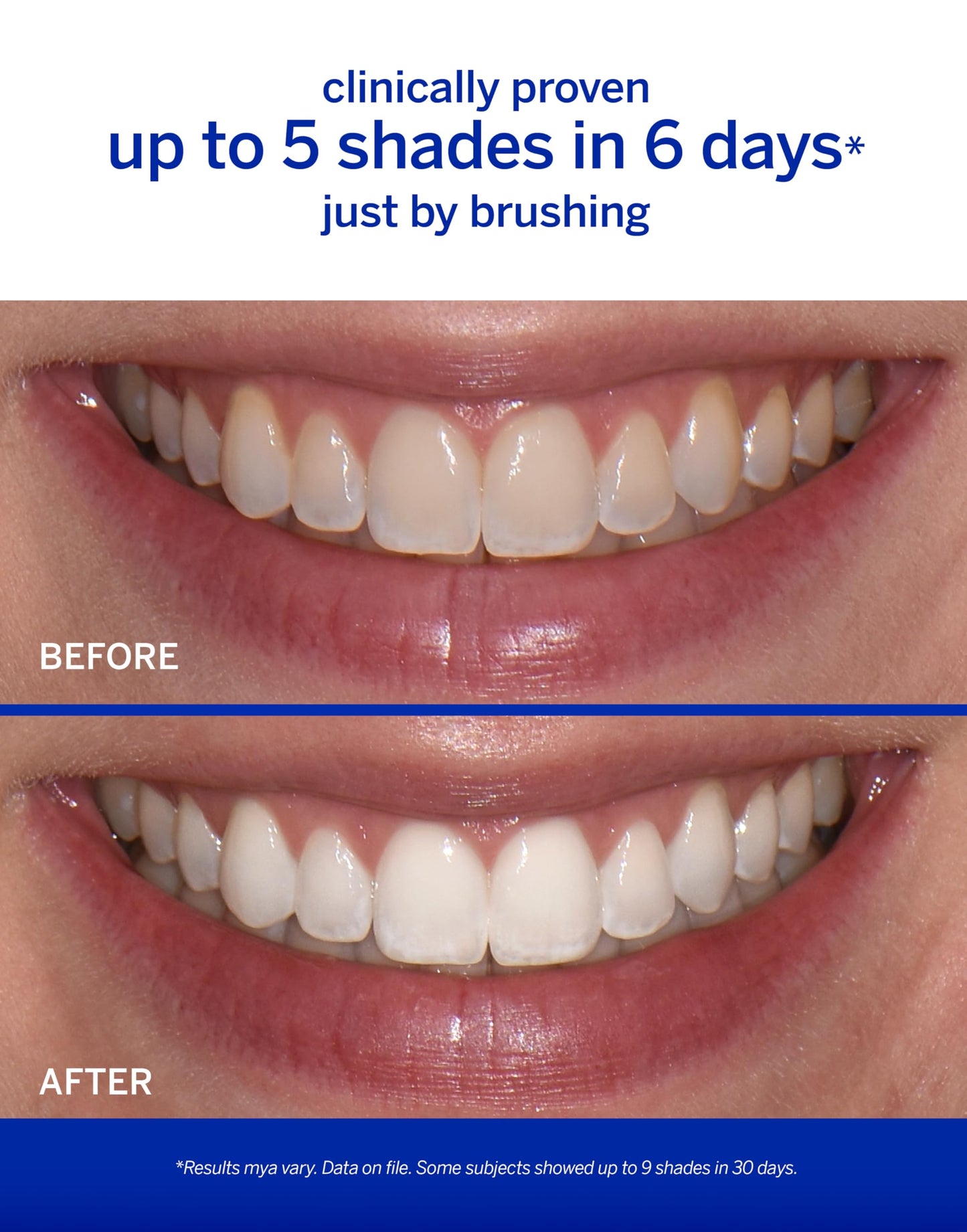 Supersmile The Works – Professional Whitening Toothpaste and Accelerator Duo – Whitens Up to 6 Shades