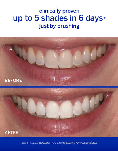 Supersmile The Works – Professional Whitening Toothpaste and Accelerator Duo – Whitens Up to 6 Shades
