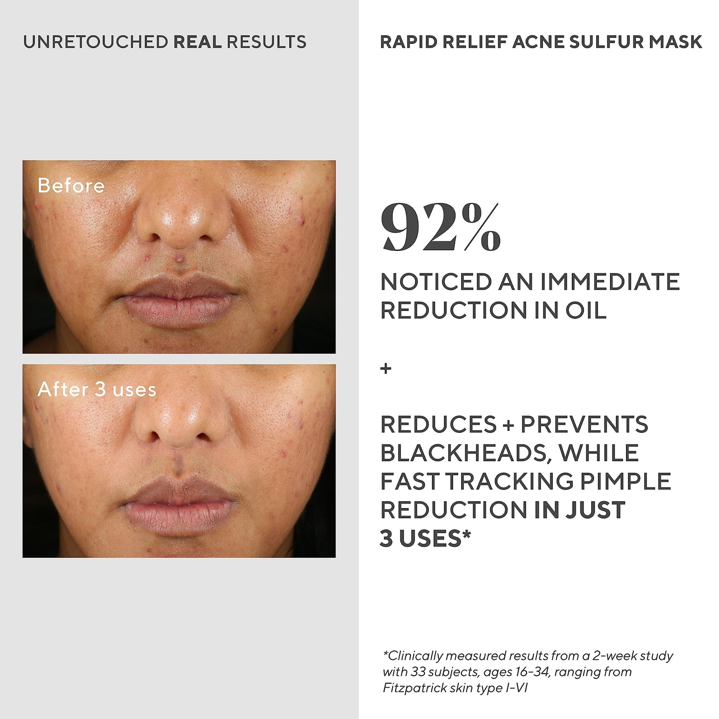 Murad Rapid Relief Acne Sulfur Mask – Clay Mask with Salicylic Acid, 5% Sulfur, and Austrian Peat Reduces Oil, Minimizes Breakouts, Reduces Pimple Size, and Unclogs Pores – 2.5 Fl Oz