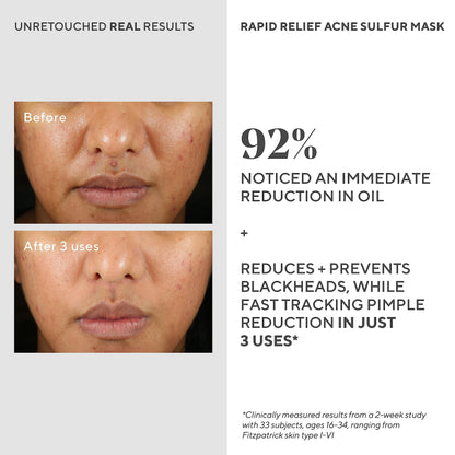 Murad Rapid Relief Acne Sulfur Mask – Clay Mask with Salicylic Acid, 5% Sulfur, and Austrian Peat Reduces Oil, Minimizes Breakouts, Reduces Pimple Size, and Unclogs Pores – 2.5 Fl Oz