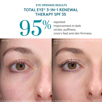 Colorescience Total Eye 3-in-1 Anti-Aging Renewal Therapy for Wrinkles & Dark Circle