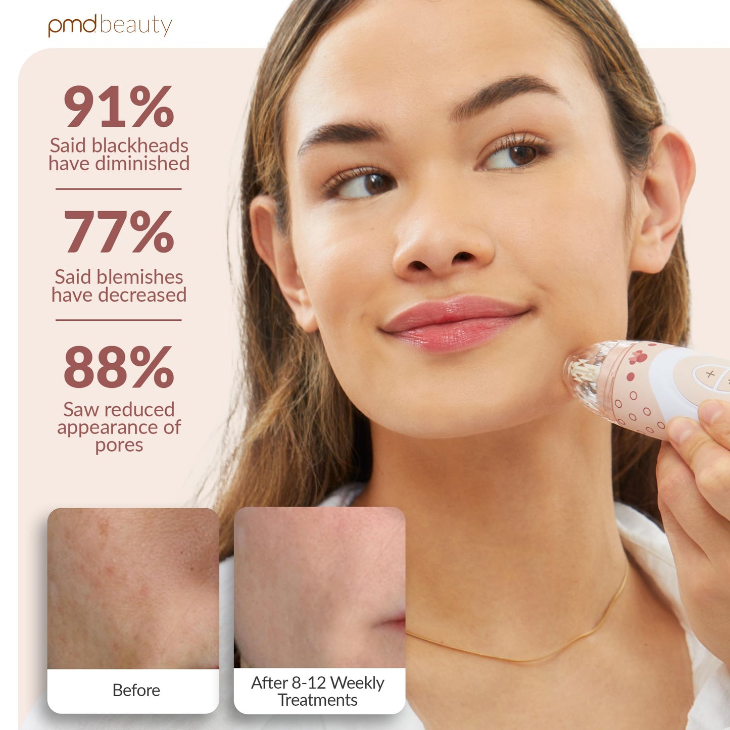 PMD Beauty x Disney Minnie Mouse Personal Microderm Elite Pro-At-Home Microdermabrasion Machine for Face and Body-Exfoliating Crystals & Vacuum Suction for Fresh & Radiant Skin-TruTier Technology