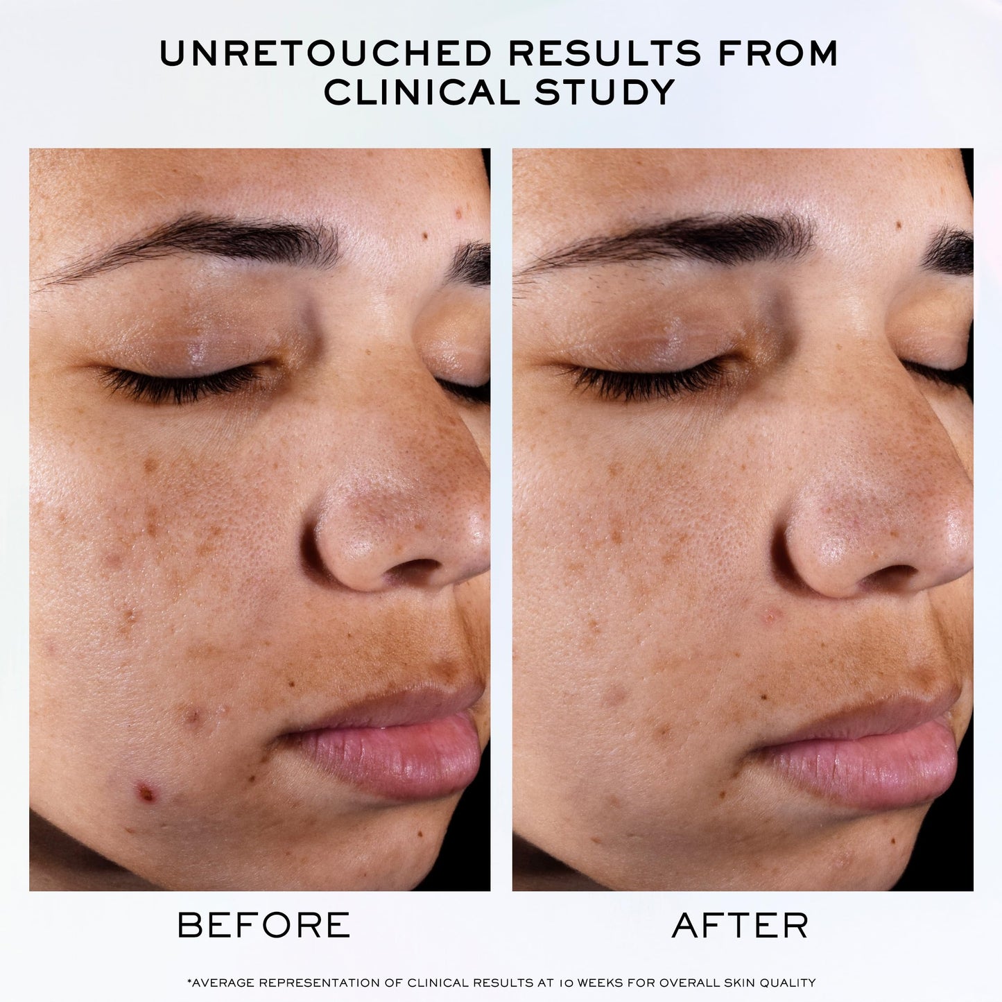 Lancôme Clarifique Pro-Solution Face Serum - Facial Serum For Visibly Reducing Dark Spots & Acne Spots - With 10% PHA and Niacinamide
