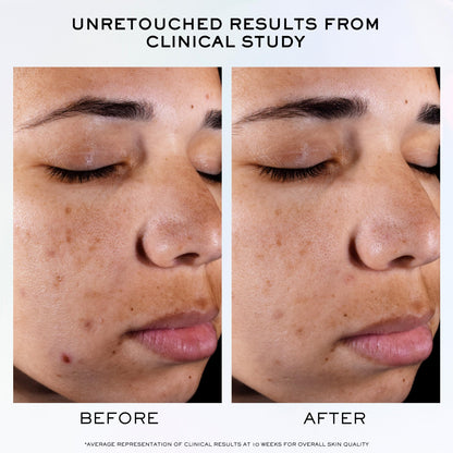 Lancôme Clarifique Pro-Solution Face Serum - Facial Serum For Visibly Reducing Dark Spots & Acne Spots - With 10% PHA and Niacinamide