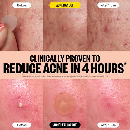 PEACE OUT Acne Day & Night Duo, Invisible Acne Patches for Day + Healing Overnight Acne Treatment, Clear Blemishes Fast with 2% Salicylic Acid, Retinol & Aloe Vera, 20 Dots