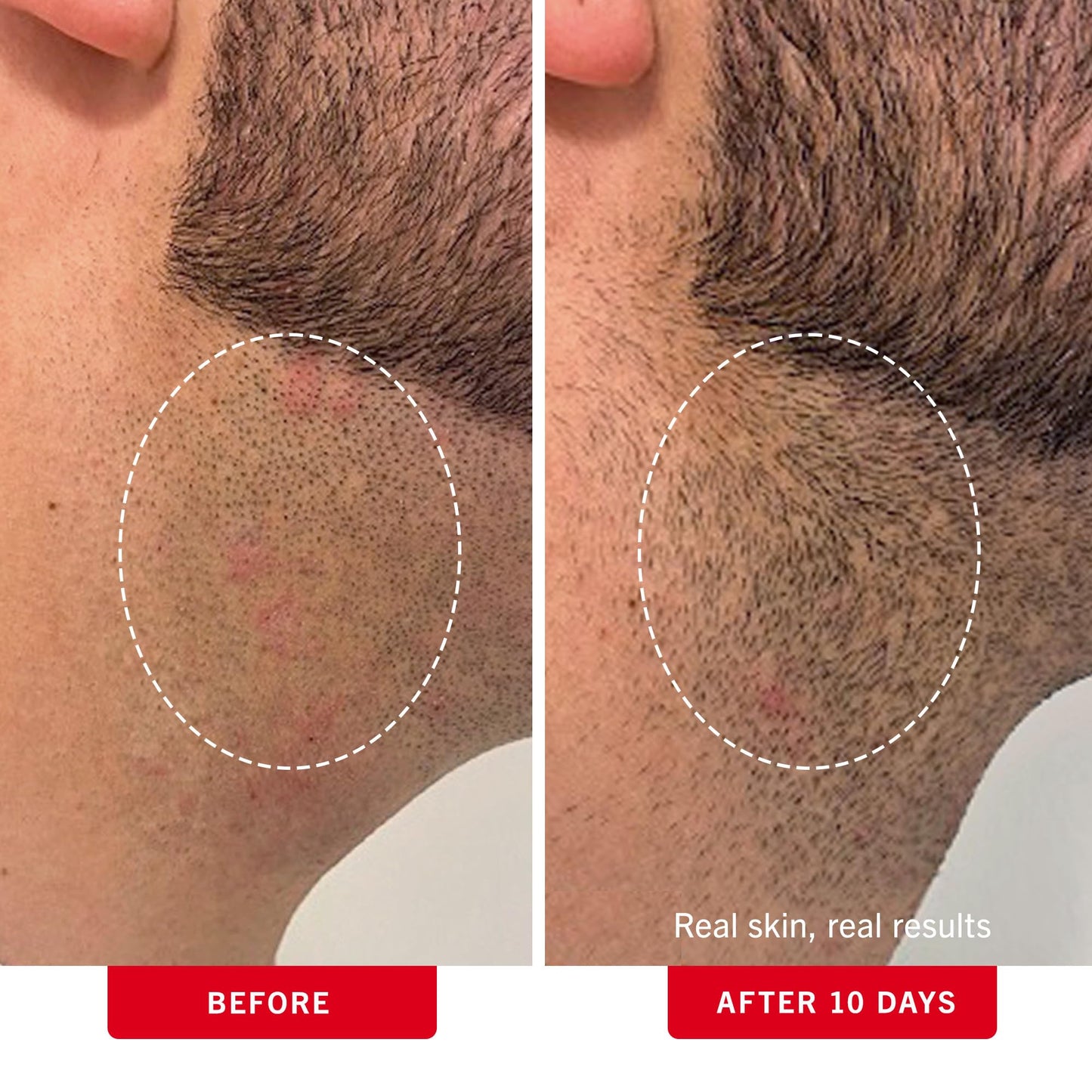 First Aid Beauty - Ingrown Hair Pads with BHA + AHA - Aftershave Treatment Pads to Help Prevent Razor Bumps for Men & Women - Exfoliate Underarms & Bikini Area - Compostable for Daily Use - 28 Pads