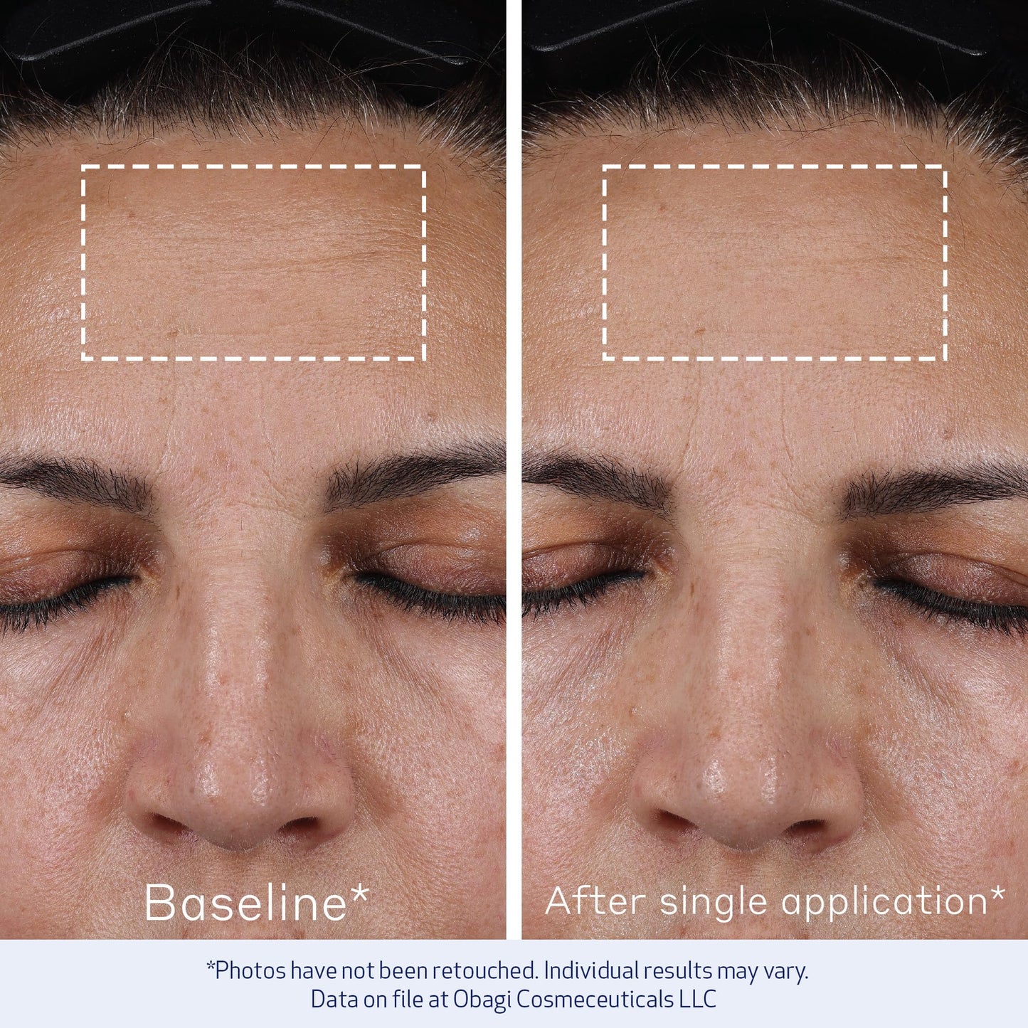 Obagi ELASTIderm Advanced Filler Concentrate – Clinically Proven Non-Injectable Filler with Biomimetic Peptide Technology that Firms Skin & Reduces the Appearance of Fine Lines & Wrinkles