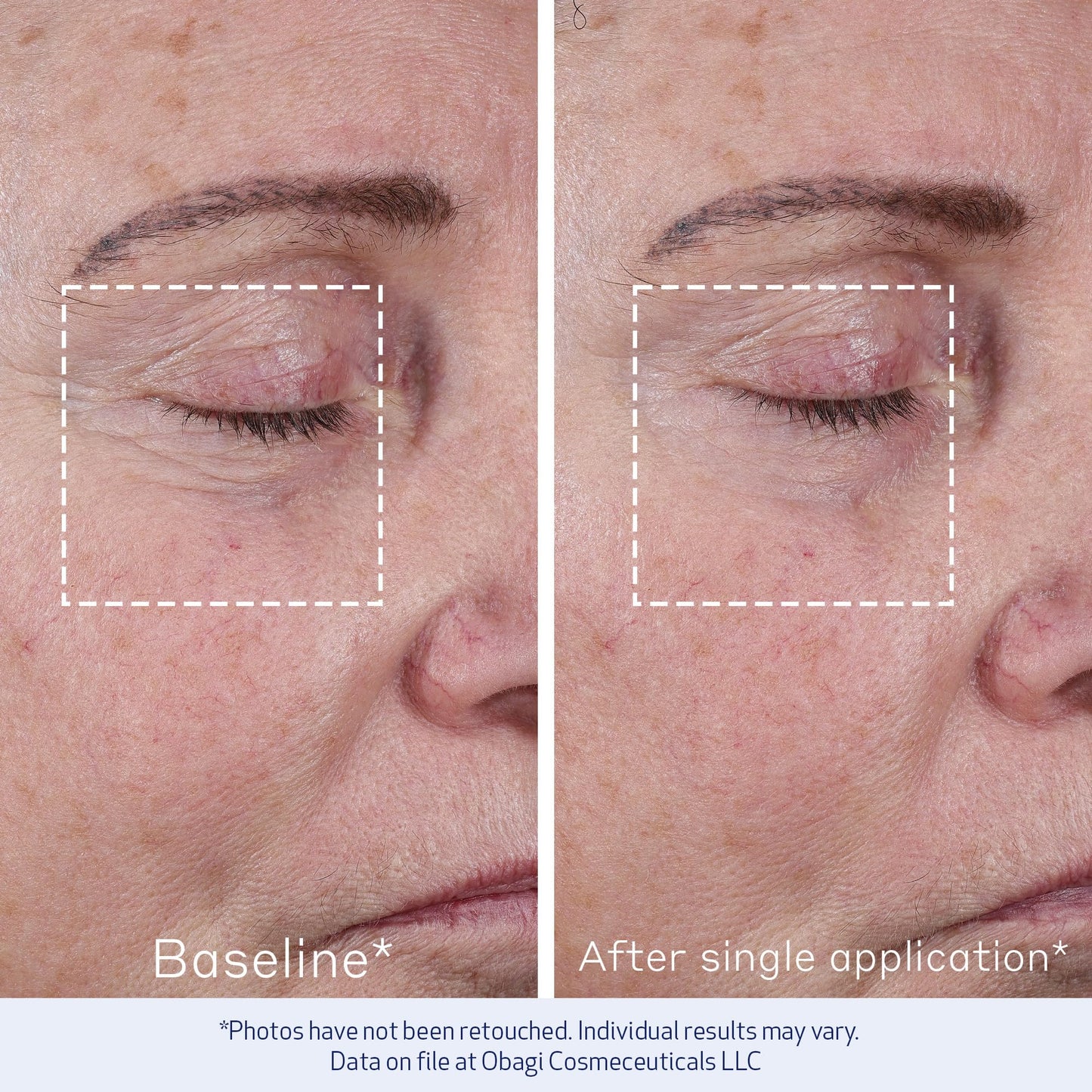 Obagi ELASTIderm Advanced Filler Concentrate – Clinically Proven Non-Injectable Filler with Biomimetic Peptide Technology that Firms Skin & Reduces the Appearance of Fine Lines & Wrinkles