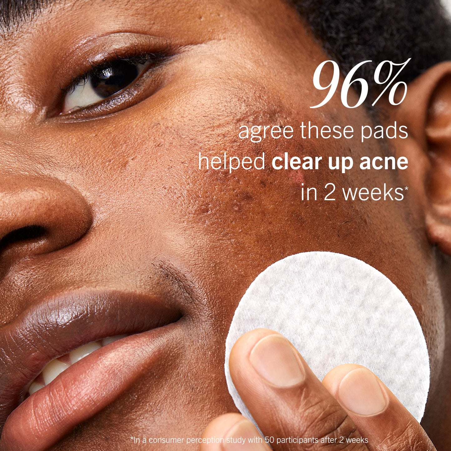 First Aid Beauty Acne Pads for Face - Maximum Strength Acne Treatment - 2% Salicylic Acid Pads Treat Without Drying, (60-ct)