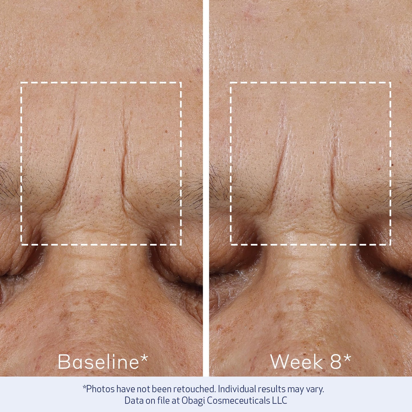 Obagi ELASTIderm Advanced Filler Concentrate – Clinically Proven Non-Injectable Filler with Biomimetic Peptide Technology that Firms Skin & Reduces the Appearance of Fine Lines & Wrinkles