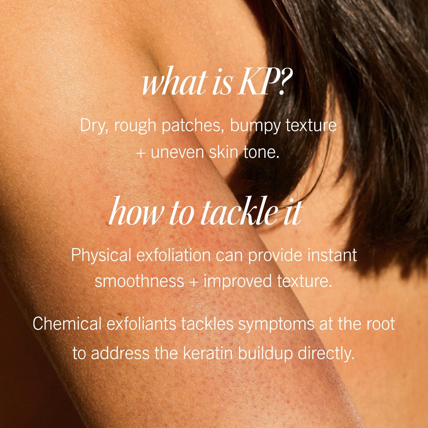 First Aid Beauty - KP Bump Eraser Body Scrub with 10% AHA, Keratosis Pilaris Exfoliator with Glycolic and Lactic acids, Helps Reduce Chicken Skin Bumps, Safe for Sensitive Skin, Strawberry Scent, 8 oz