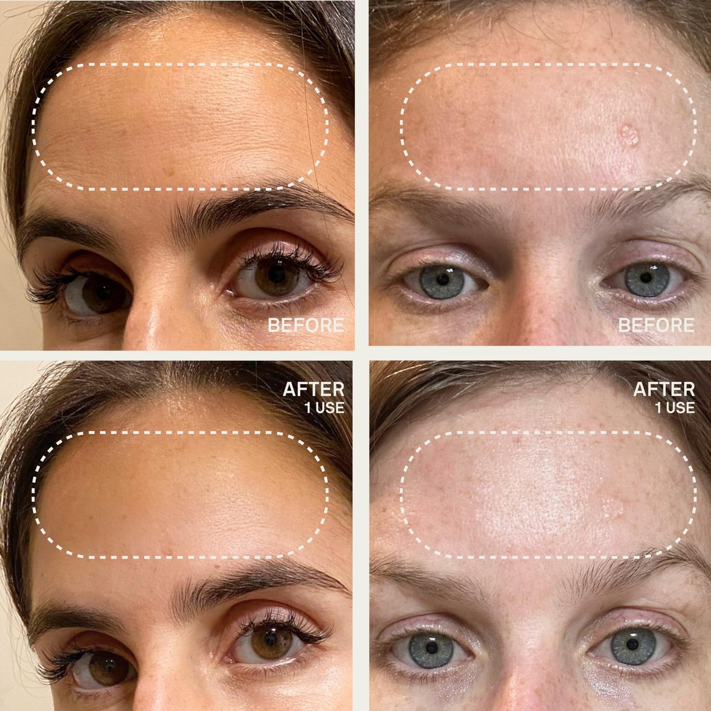 Dermaclara Forehead Patch - Forehead Wrinkle Patches for Face Overnight, Dermaclara Silicone Patches, Reusable for Face, Treatment for Wrinkles, Repair & Restore, Up to 30 Uses - 1 Patch