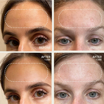 Dermaclara Forehead Patch - Forehead Wrinkle Patches for Face Overnight, Dermaclara Silicone Patches, Reusable for Face, Treatment for Wrinkles, Repair & Restore, Up to 30 Uses - 1 Patch