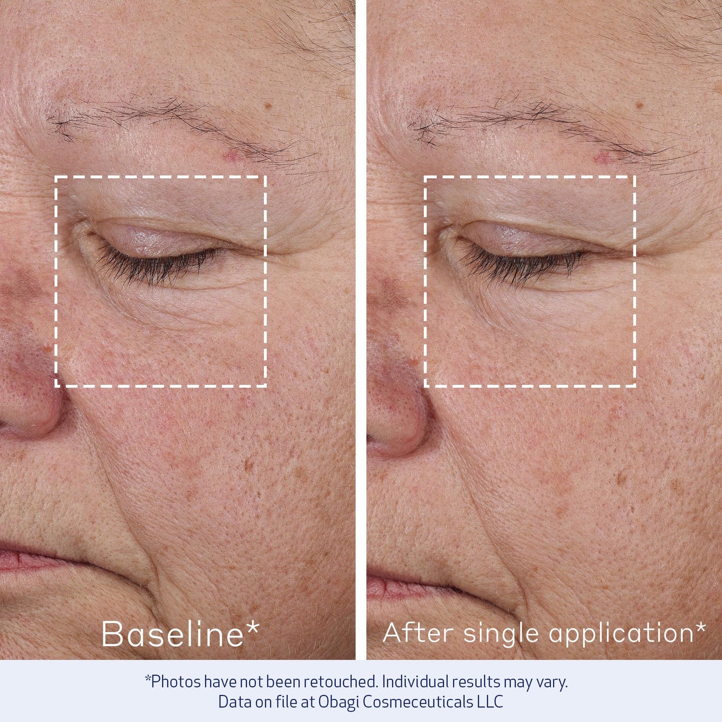 Obagi ELASTIderm Advanced Filler Concentrate – Clinically Proven Non-Injectable Filler with Biomimetic Peptide Technology that Firms Skin & Reduces the Appearance of Fine Lines & Wrinkles